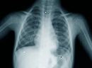 Costochondritis